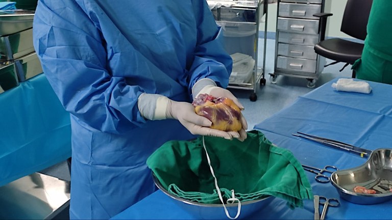 Transplante de Coração Central Estadual de Transplante na Paraíba2